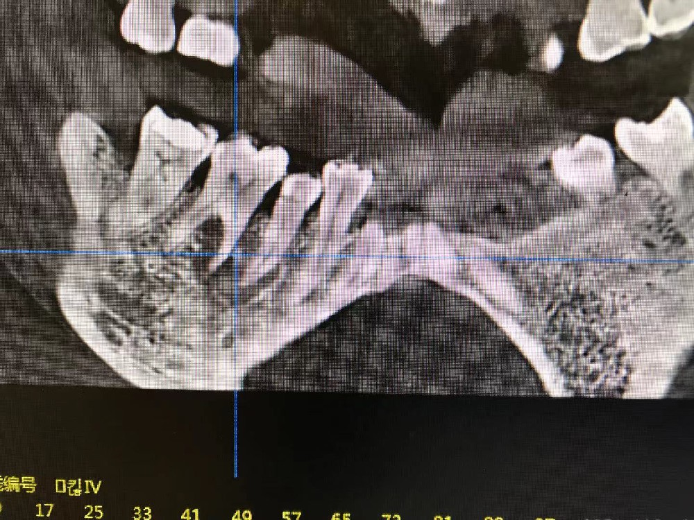 如何看口腔CT牙片